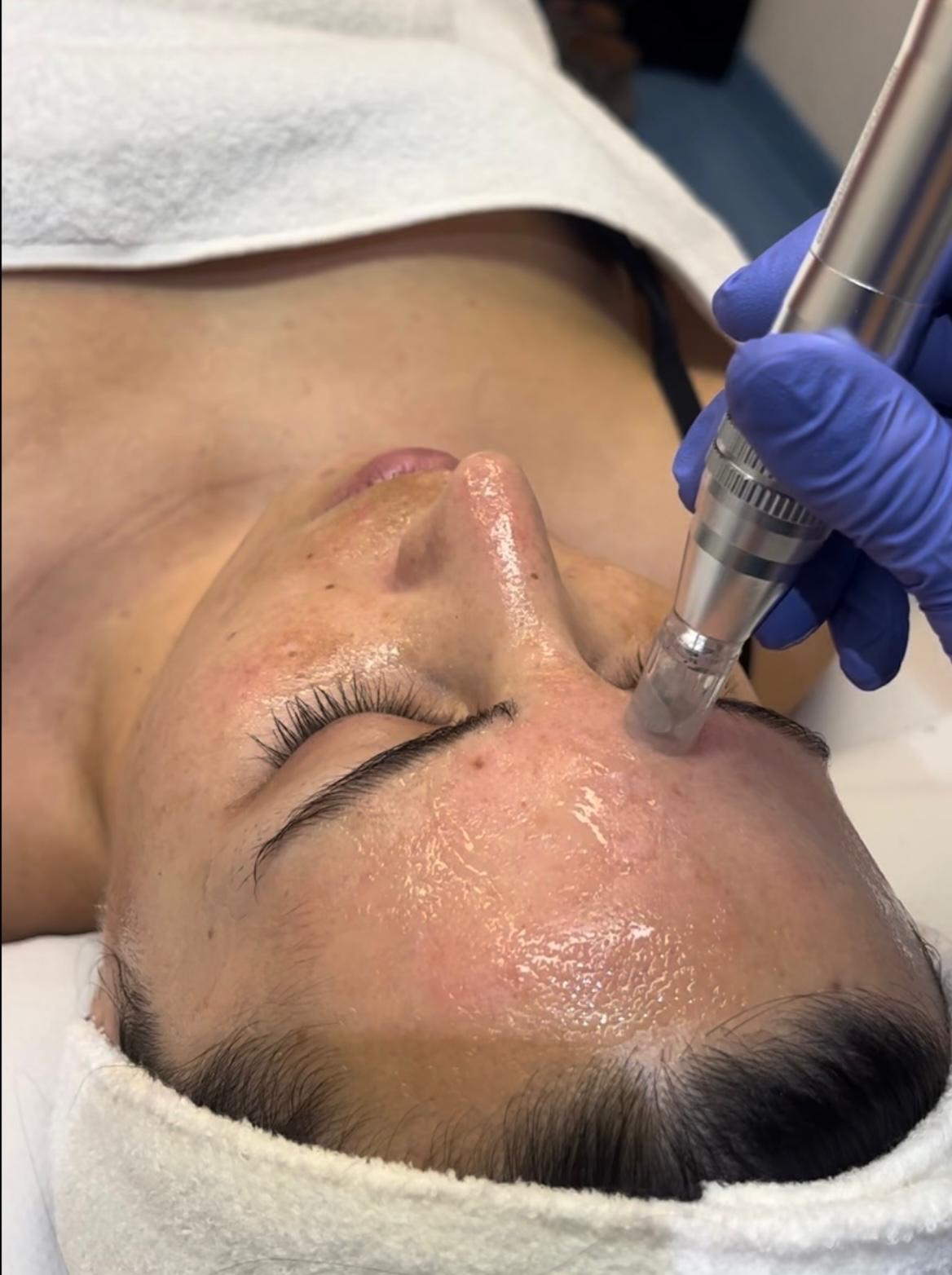 Microneedling Dermapen